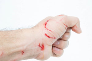 Cat Bite on Hand